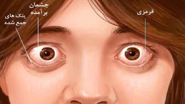 نقش بیماری تیروئید در بروز اختلال بینایی